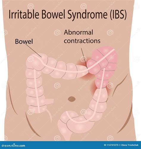 Irritable Bowel Syndrome IBS in a Large Intestine Stock Vector