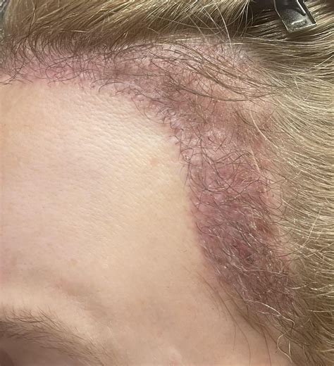 [update] 12 weeks out FUE, 2500 grafts to cover scar (female, no hair