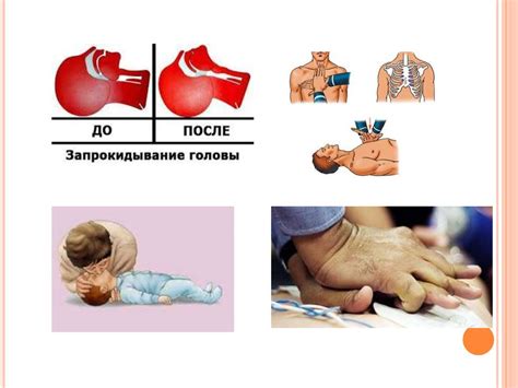 Способы реанимации детей при апноэ или попадании инородного тела в ...