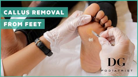 Callus On Foot Removal
