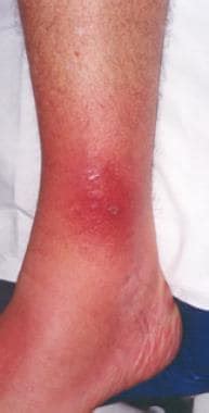 cellulitis infection dr axe health  fitness news recipes