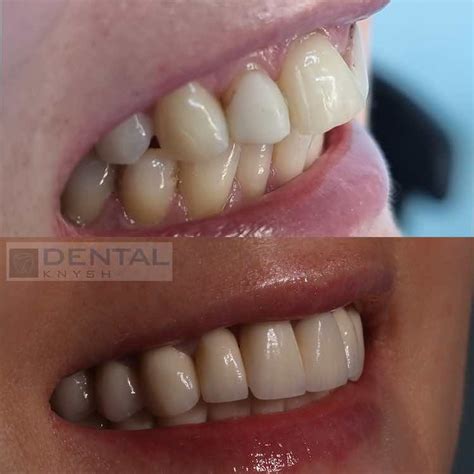 Вініри Львів | Вініри ціна Львів | Стоматологія DentalKnysh