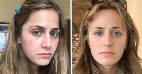 Periorbital Dermatitis Eyes