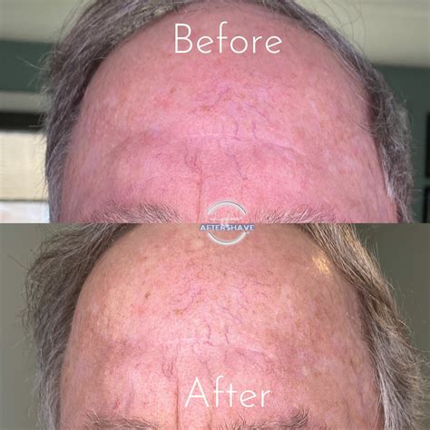 Fluorouracil Before And After Pictures