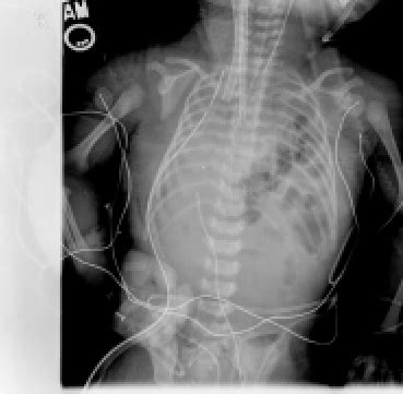radiograph  chest demonstrating total opacification   lung
