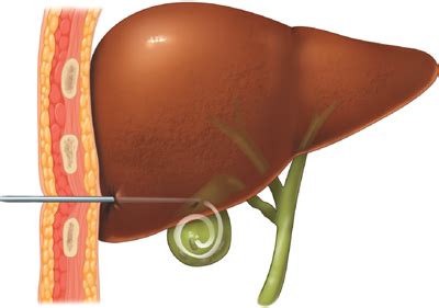 percutaneous cholecystostomy long term outcomes  endoscopic