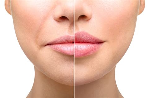 Dermal Fillers Wellington - Cheek And Lip Fillers