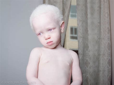 15+ Albino People Who’ll Mesmerize You With Their Otherworldly Beauty ...