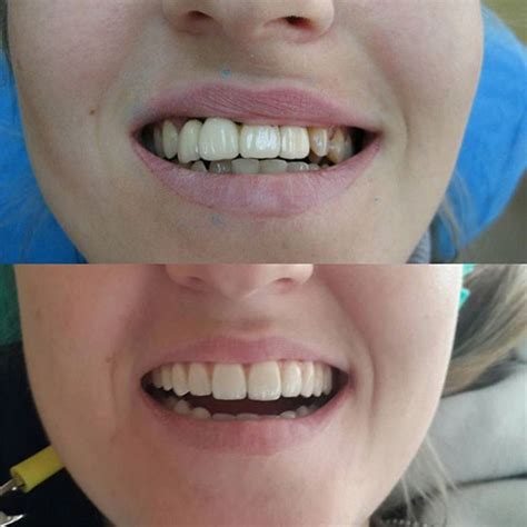 Фото до и после лечения — Стоматология в Одессе — СтоматЦентр, Одесса, цены