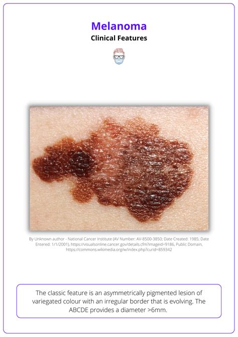 Melanoma: Diagnosis, Features, Sentinel Node, & Staging