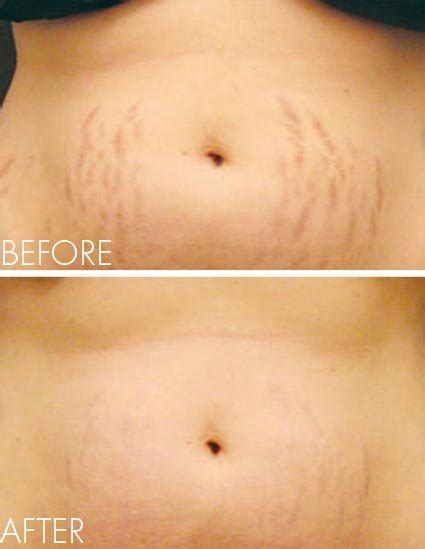 Scottsdale's #1 Choice for ProCell Microchanneling