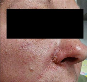 Blastomycosis Skin Lesions