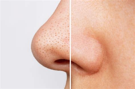 Unbelievable Blackhead Removal 2024: 5 Things You NEED To Know Before You Start! Image 16