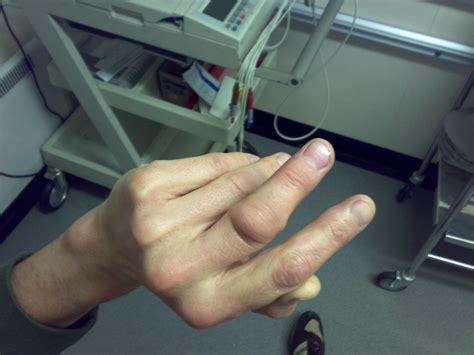 how to know if i dislocated my finger