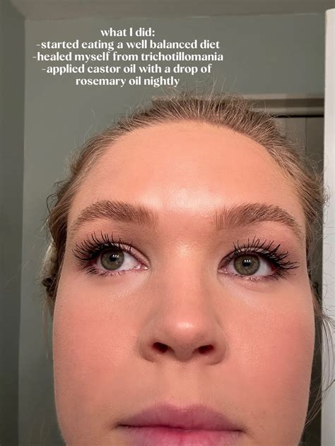 Trichotillomania Eyebrows