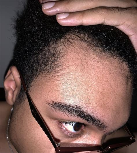 2 months vellus hair growth thanks to minox mostly : r/tressless