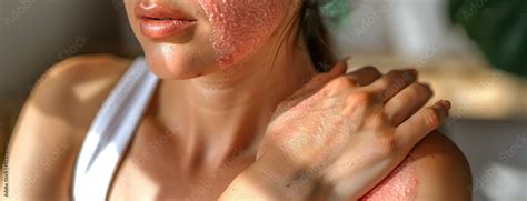 Young Woman with Allergy or Insect Bites, Scratching Itchy Red Rash on ...