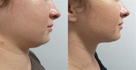 vial  kybella  ha overton blog