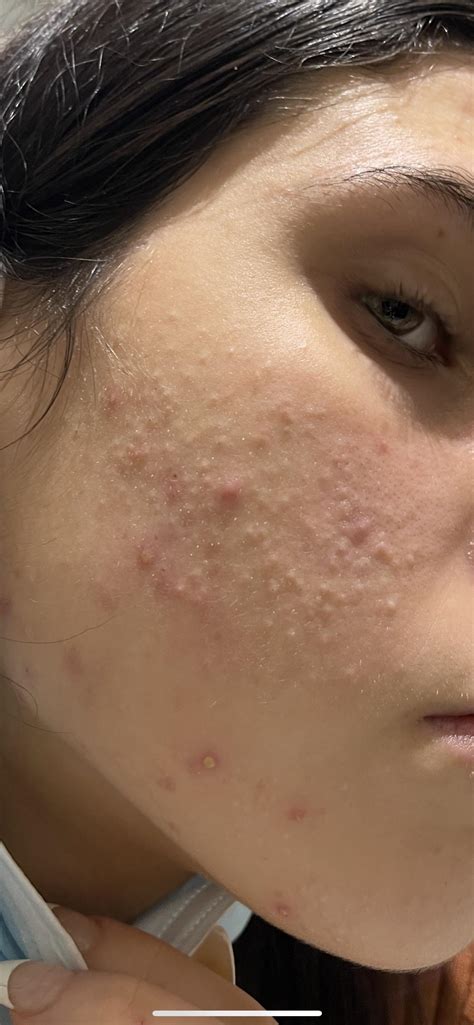 Juicy Pimple Pop Videos 13