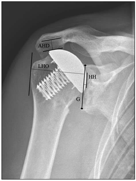 JCM | Free Full-Text | Glenoid Component Loosening in Anatomic Total ...