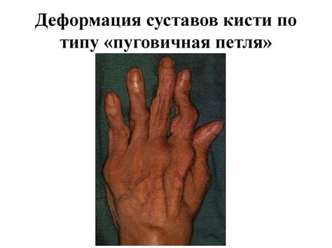 Ревматоидный артрит - презентация онлайн