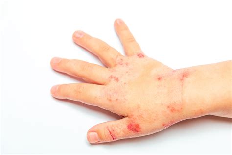 Roflumilast cream 0.05% demonstrates eczema area severity, itch ...
