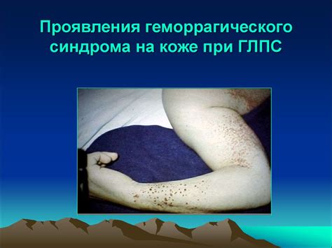 Лептоспироз. ГЛПС - презентация онлайн