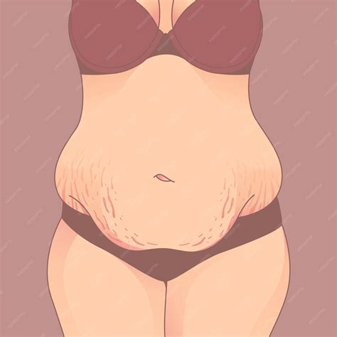 Premium Vector | Belly with stretch marks, Saggy skin removal. woman