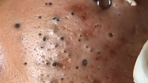 Unbelievable Blackhead Removal 2024: From Blemishes to Beautiful Skin - syju2gi