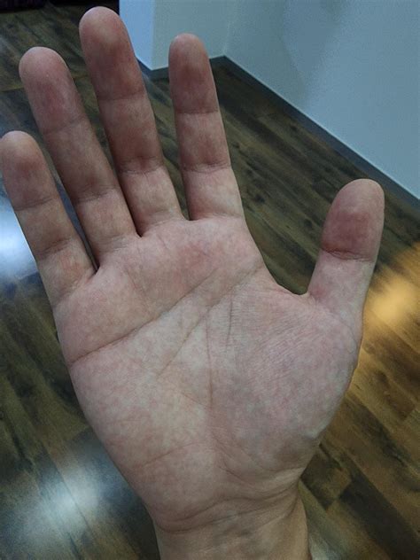 Palms of my hands have red patches or rashes : r/DiagnoseMe