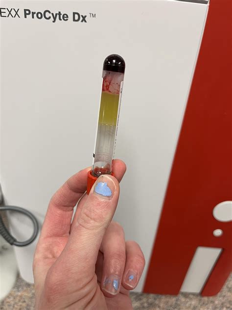Has anyone seen this before? Icteric serum that is a jello like