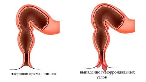 Нигепан свечи: инструкция по применению при геморрое