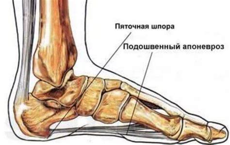 Пяточная шпора фото, симптомы и лечение в домашних условиях