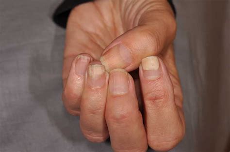 Onycholysis - Dermatology Advisor