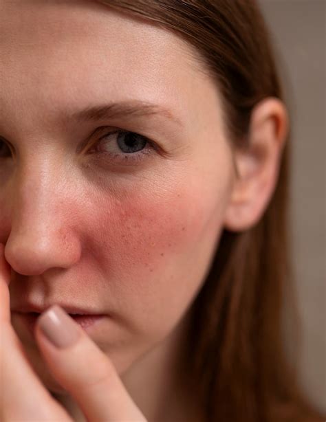 Laser For Redness In Singapore | By Dr Lee Hwee Chyen