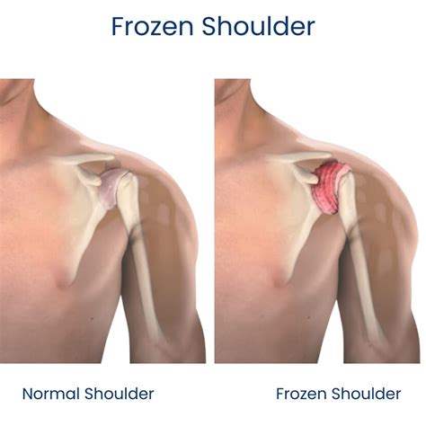 relieve shoulder pain  lifting  arm pain physicians ny
