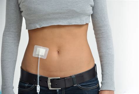 Peritoneal Dialysis (PD) – Sapiens Health Foundation