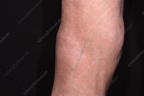 popliteal aneurysm stock image  science photo library
