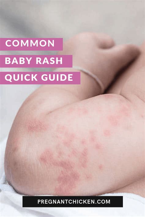 Types of baby rashes – Artofit