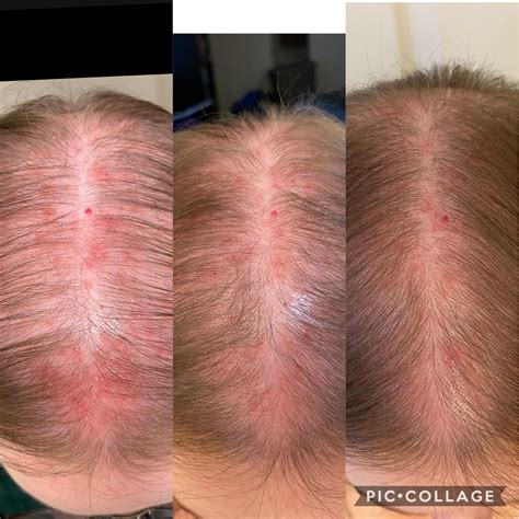 304 best Folliculitis images on Pholder | Folliculitis, Skincare