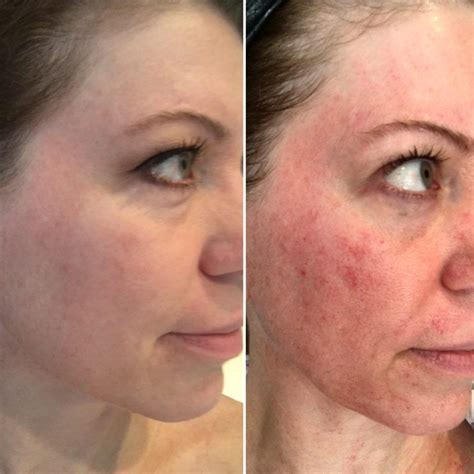 Albums 94+ Pictures Before And After Pictures Of Microdermabrasion Sharp