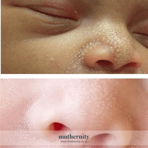 White spots or milia in newborns - Mothernity