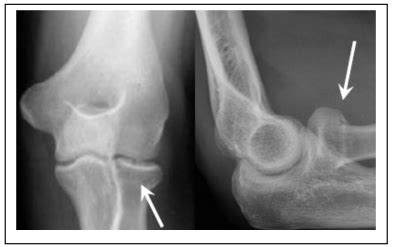 Radial Head / Neck Fracture — Chelsea and Westminster Hospital NHS ...