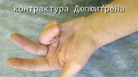 Лечение контрактуры Дюпюитрена. Клинический случай. - YouTube