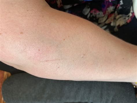 Yshaped vein-run hand over,sharp pain on skin.cut not sore. : r/medical