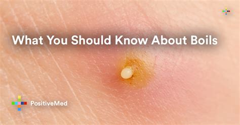 What Causes Boil At The Buttocks at Alice Manning blog