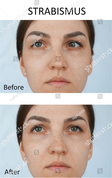 strabismus squint blackrock eye care