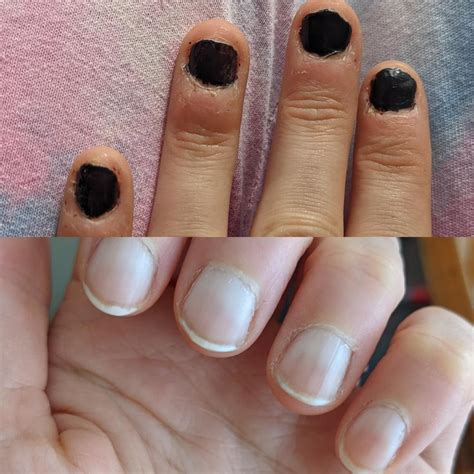 Life long nail biter 1 month progress! It is possible! : nailbiting