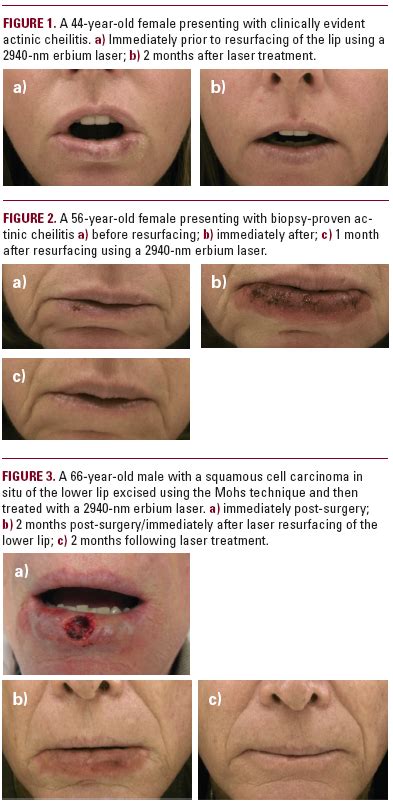 Actinic Cheilitis