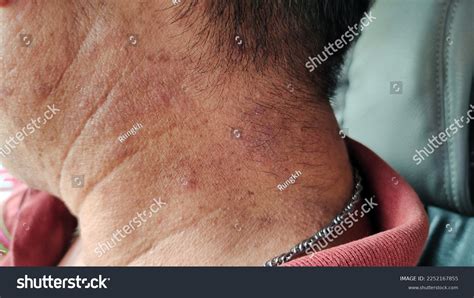 Portrait Showing Chronic Dermatitis On Neck Stock Photo 2252167855 ...